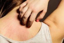 Doctors Explain How Kidney Disorders Can Show Up Through Skin Changes