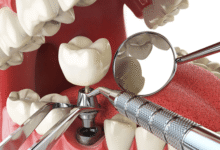 How Advanced Implant Techniques Are Changing Dentistry