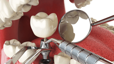 How Advanced Implant Techniques Are Changing Dentistry