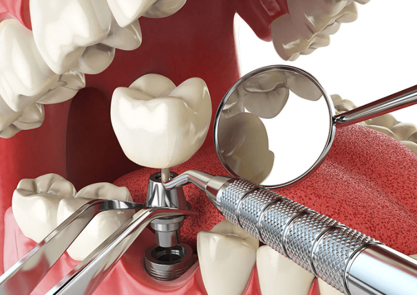 How Advanced Implant Techniques Are Changing Dentistry