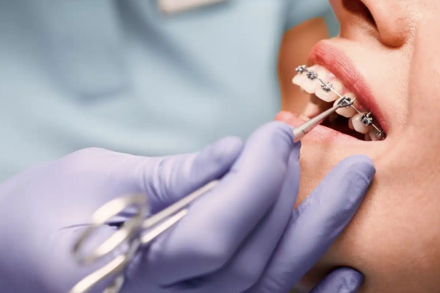 Why Orthodontists Are Essential For Complex Dental Cases