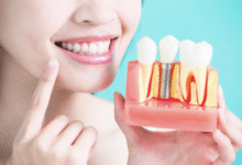 6 Tips For Caring For Dental Implants After Surgery