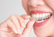 3 Ways Clear Aligners Improve Comfort During Treatment