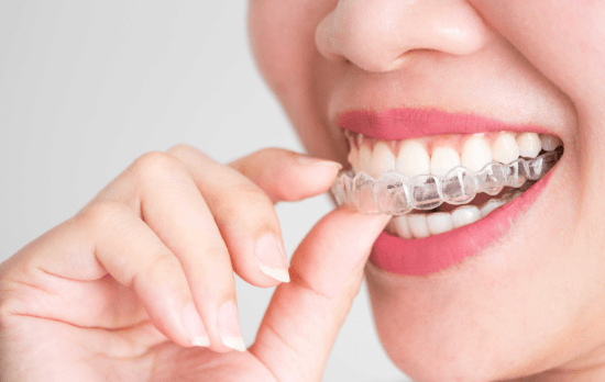 3 Ways Clear Aligners Improve Comfort During Treatment