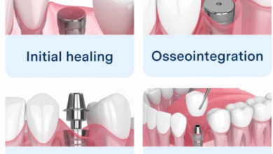 4 Essential Steps In The Dental Implant Process