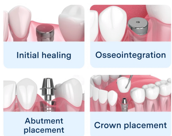 4 Essential Steps In The Dental Implant Process